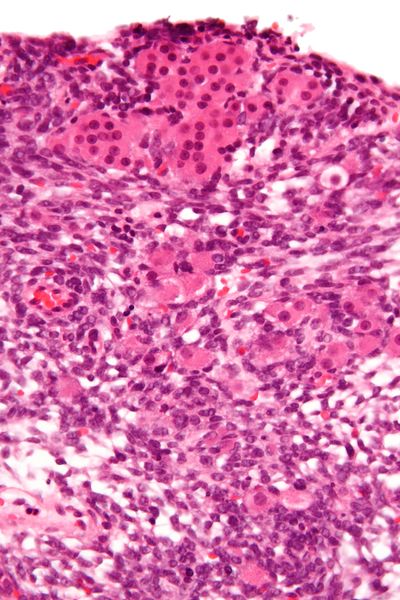 File:Sertoli-Leydig cell tumour - very high mag.jpg