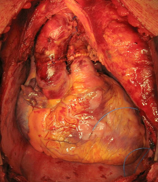 文件:Пересаженное сердце в грудной клетке реципиента.JPG
