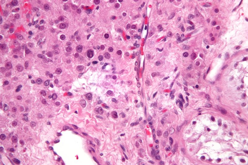 文件:Leydig cell tumour3.jpg