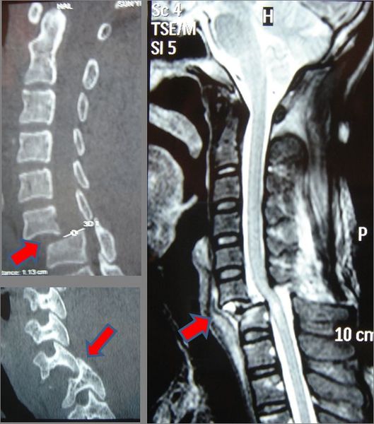 File:颈椎骨折MRI.jpg