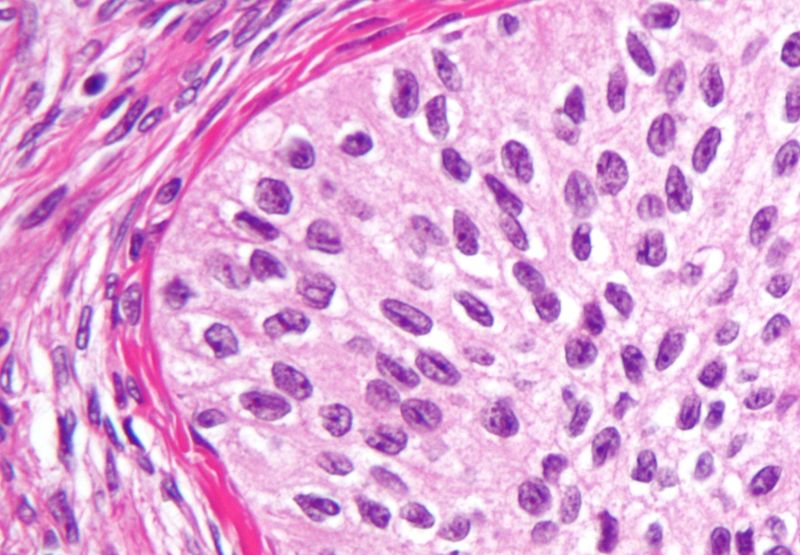 File:Brenner tumour high mag cropped.jpg