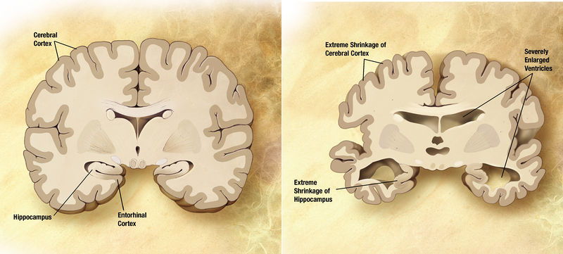 文件:Alzheimer's disease brain comparison.jpg