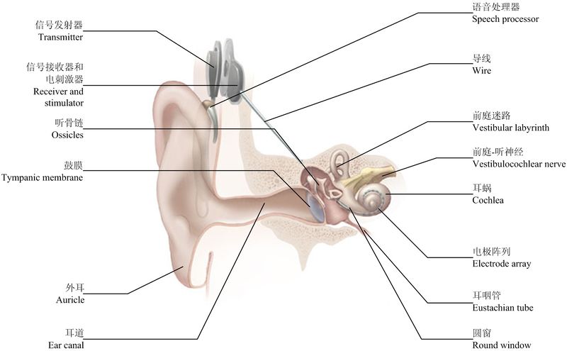 文件:Cochlear Implant 1.jpg