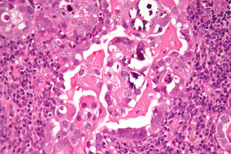 文件:Uterine serous carcinoma high mag.jpg