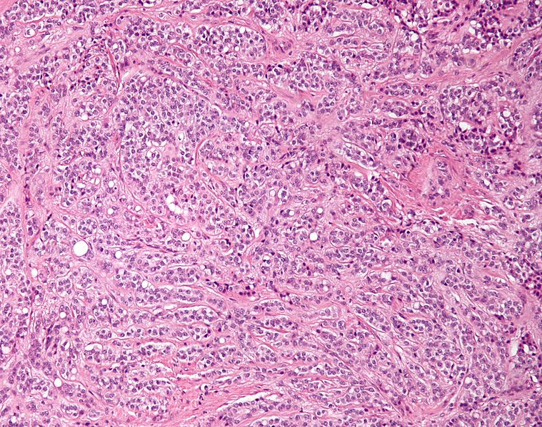 文件:Sertoli cell tumour low mag.jpg