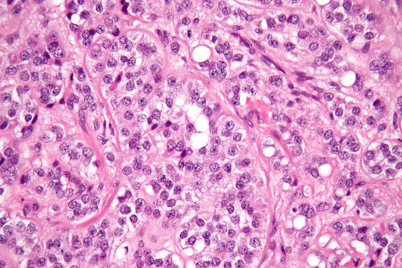文件:Sertoli cell tumour high mag.jpg