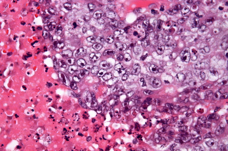 文件:Embryonal carcinoma - very high mag - cropped.jpg