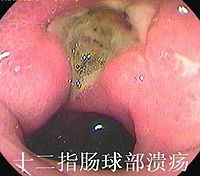 子 腸 潰瘍 12 胃・十二指腸 潰瘍