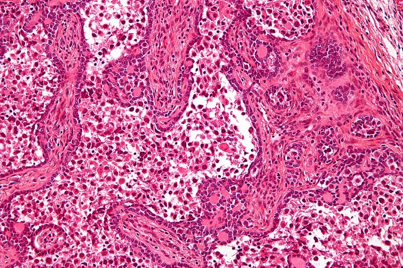 File:Gonadoblastoma - b - high mag.jpg