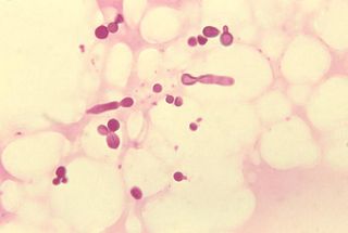 放大花斑癣病患皮屑所看到的秕糠马拉癣菌