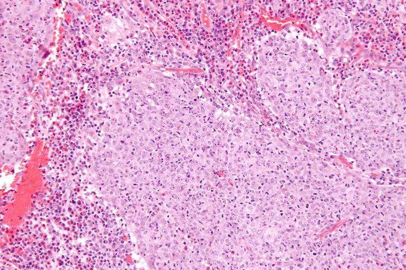 File:Glassy cell carcinoma - high mag.jpg